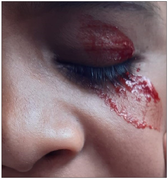 Sweat admixed with blood on the eyelids.